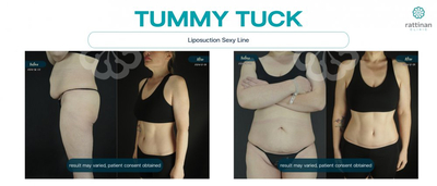 Slider image (1) Calming Confidence in Plastic Surgery at Rattinan Thailand